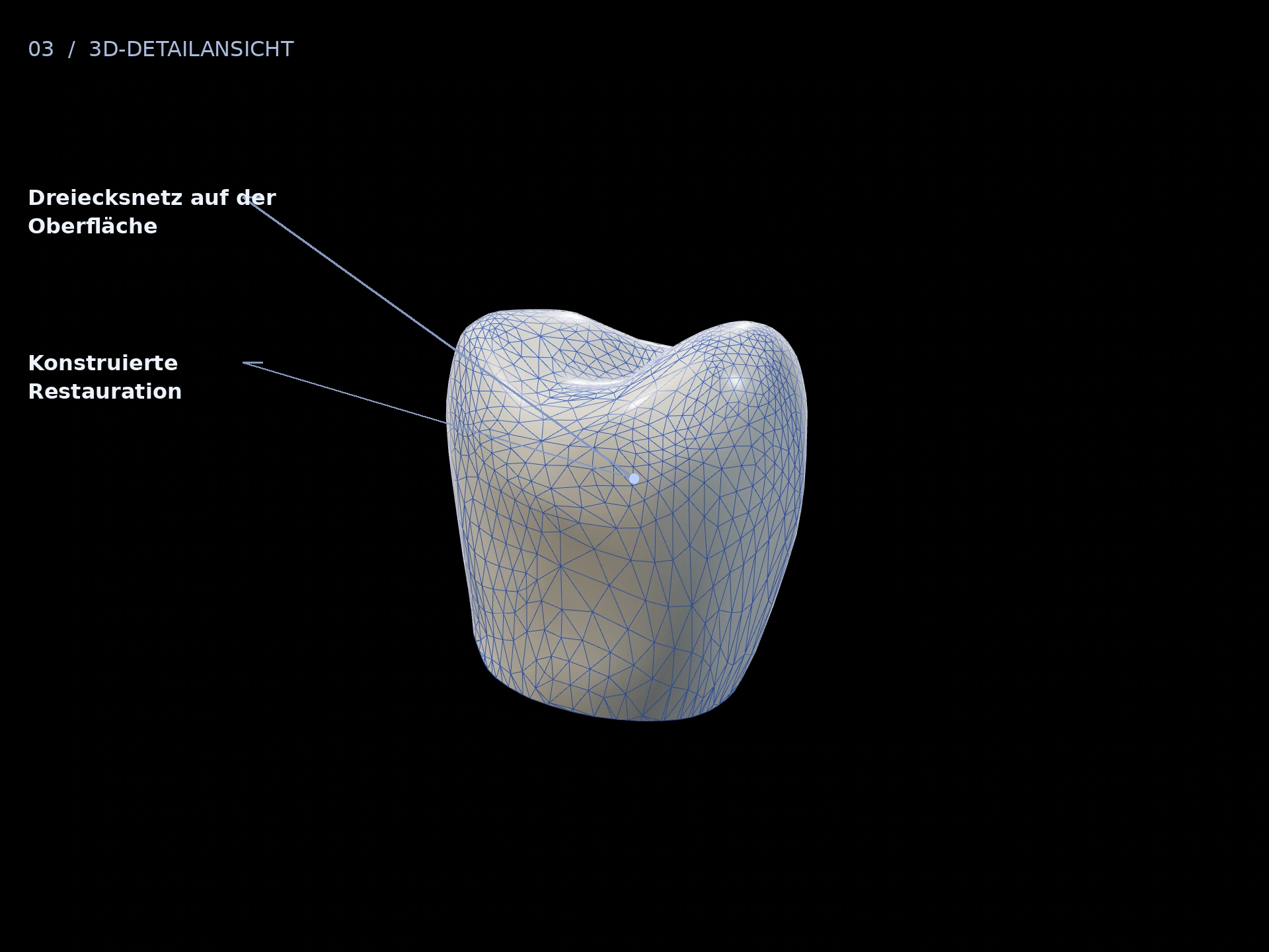 Digitale Oberfläche: beschriftete 3D-Ansicht mit Konstruierte Restauration, Dreiecksnetz auf der Oberfläche
