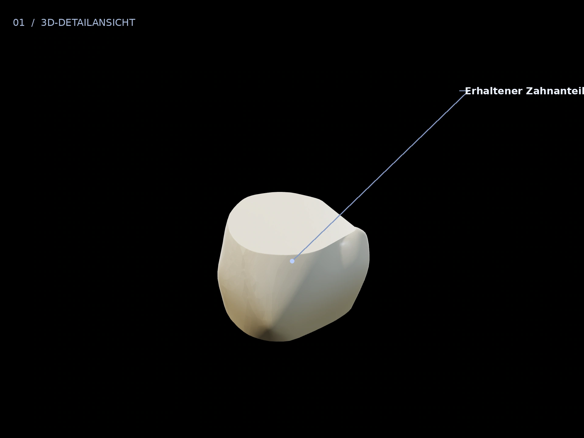 Erhaltener Zahn: beschriftete 3D-Ansicht mit Erhaltener Zahnanteil