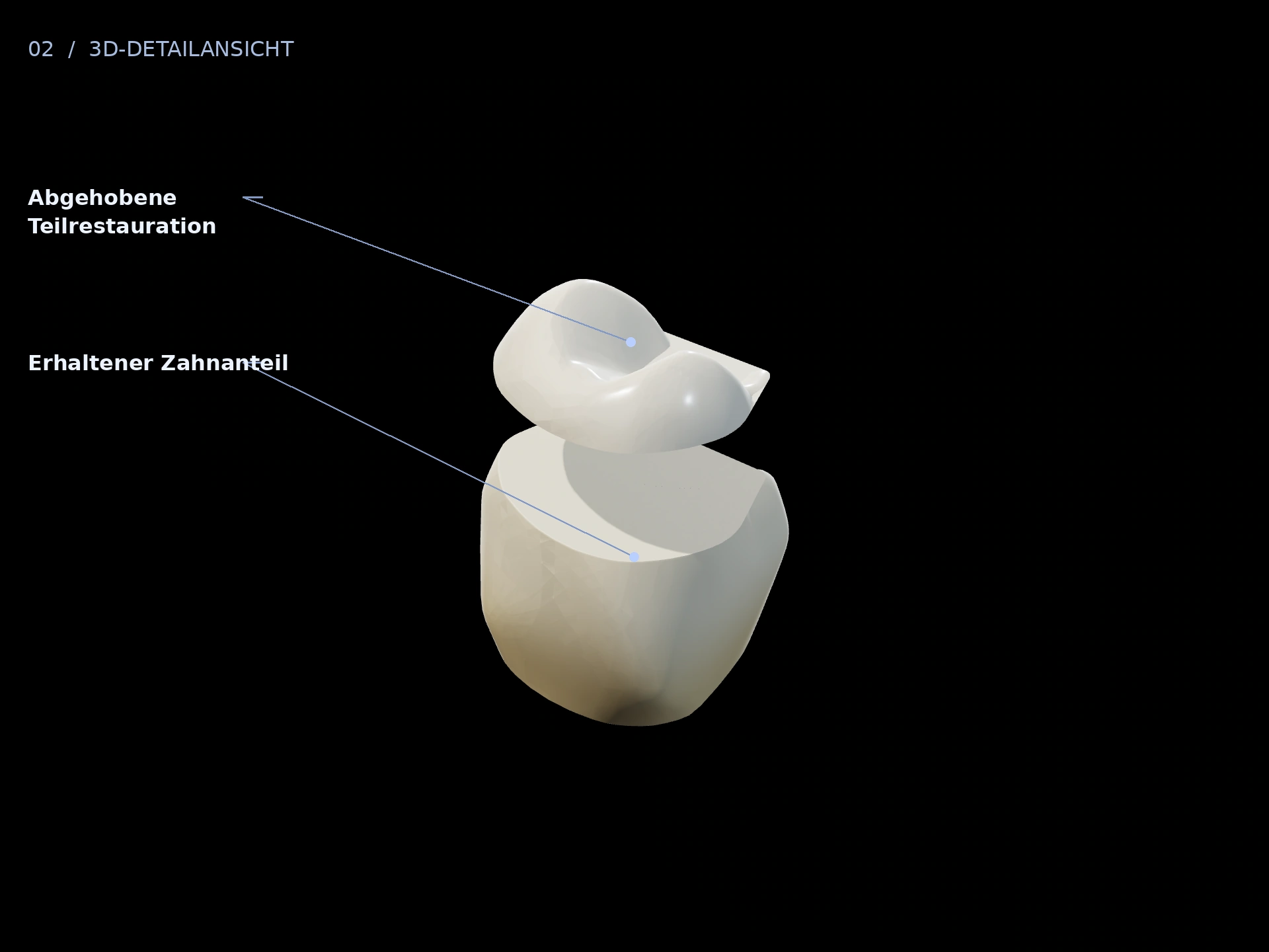 Ergänzung: beschriftete 3D-Ansicht mit Erhaltener Zahnanteil, Abgehobene Teilrestauration