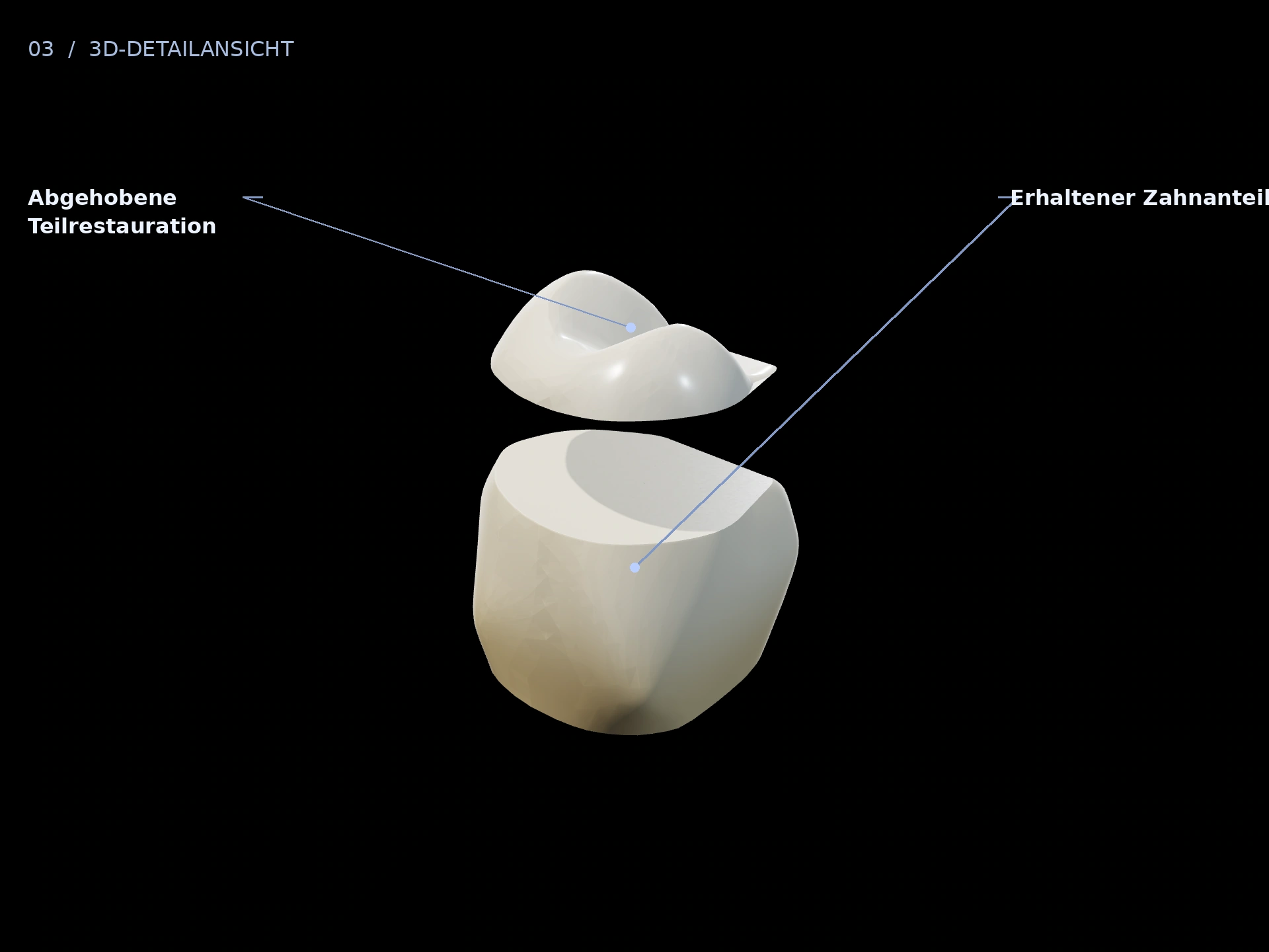 Übergang: beschriftete 3D-Ansicht mit Erhaltener Zahnanteil, Abgehobene Teilrestauration