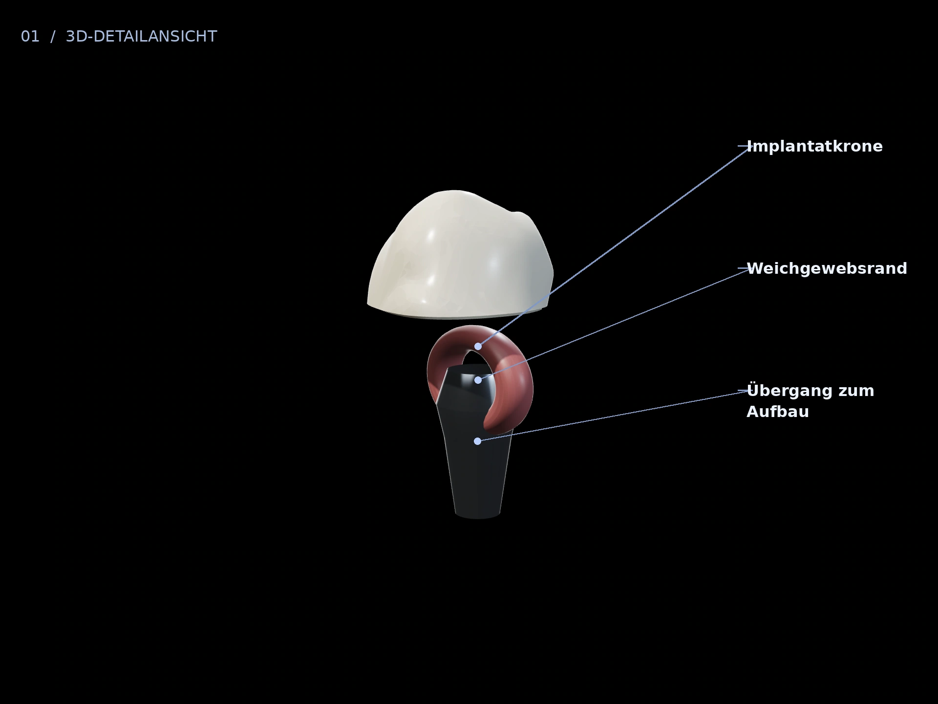 Kronenrand: beschriftete 3D-Ansicht mit Implantatkrone, Weichgewebsrand, Übergang zum Aufbau
