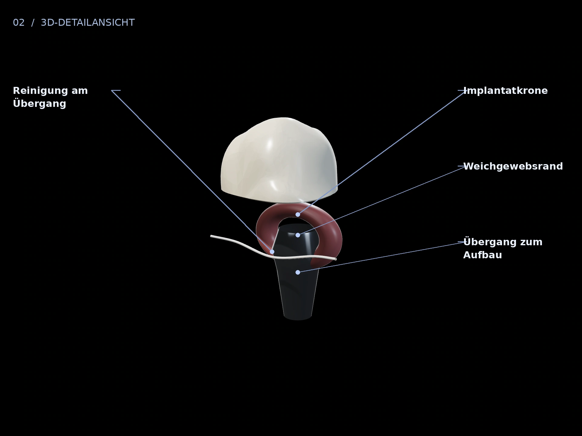 Weichgewebe: beschriftete 3D-Ansicht mit Implantatkrone, Weichgewebsrand, Übergang zum Aufbau, Reinigung am Übergang