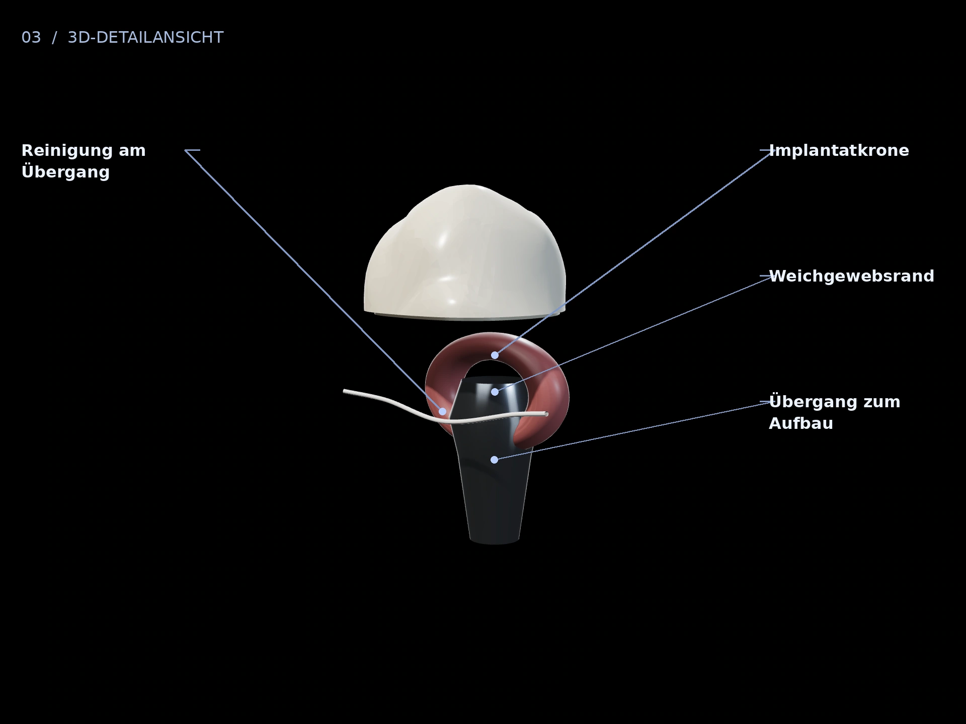 Reinigungsbereich: beschriftete 3D-Ansicht mit Implantatkrone, Weichgewebsrand, Übergang zum Aufbau, Reinigung am Übergang