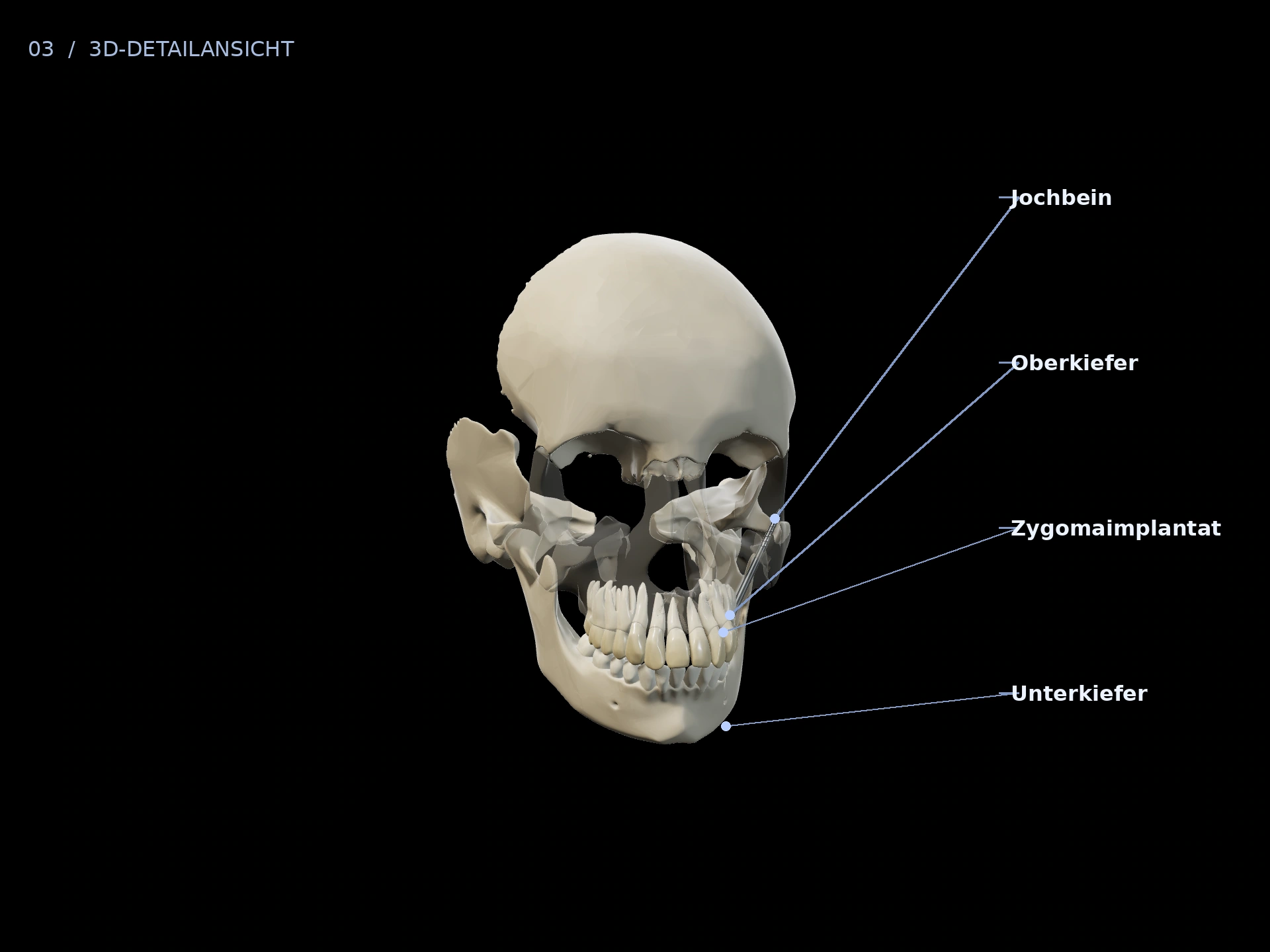 Längere Verankerung: beschriftete 3D-Ansicht mit Oberkiefer, Jochbein, Unterkiefer, Zygomaimplantat